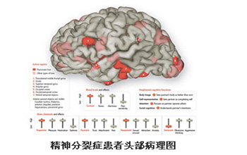 北京精神分裂治疗费用是多少